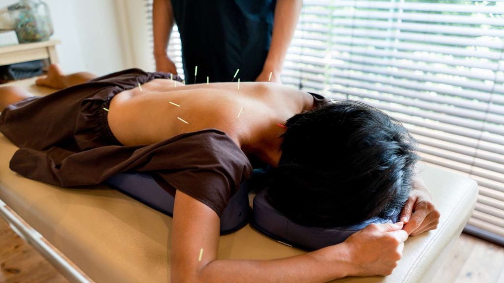 Mujer recibiendo acupuntura como parte de terapias naturales para el dolor de espalda.