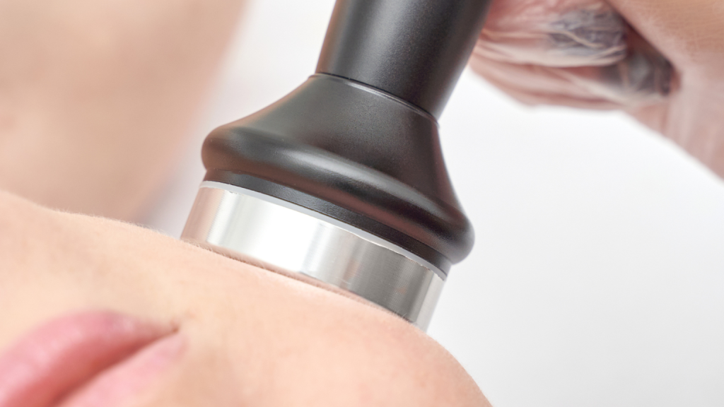 Radiofrecuencia facial