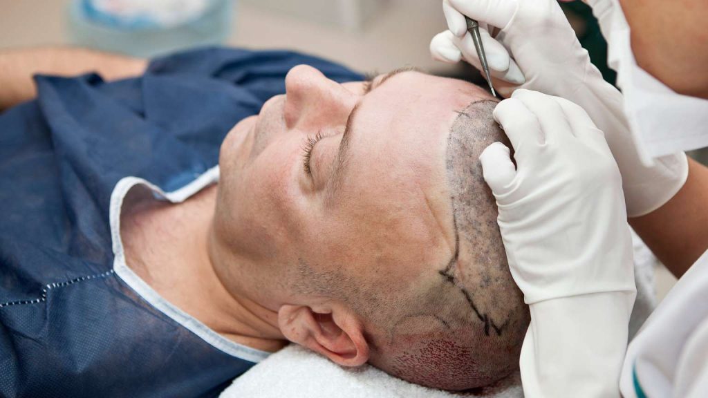 Paciente masculino recibiendo una cirugía capilar con técnica precisa en zona frontal.