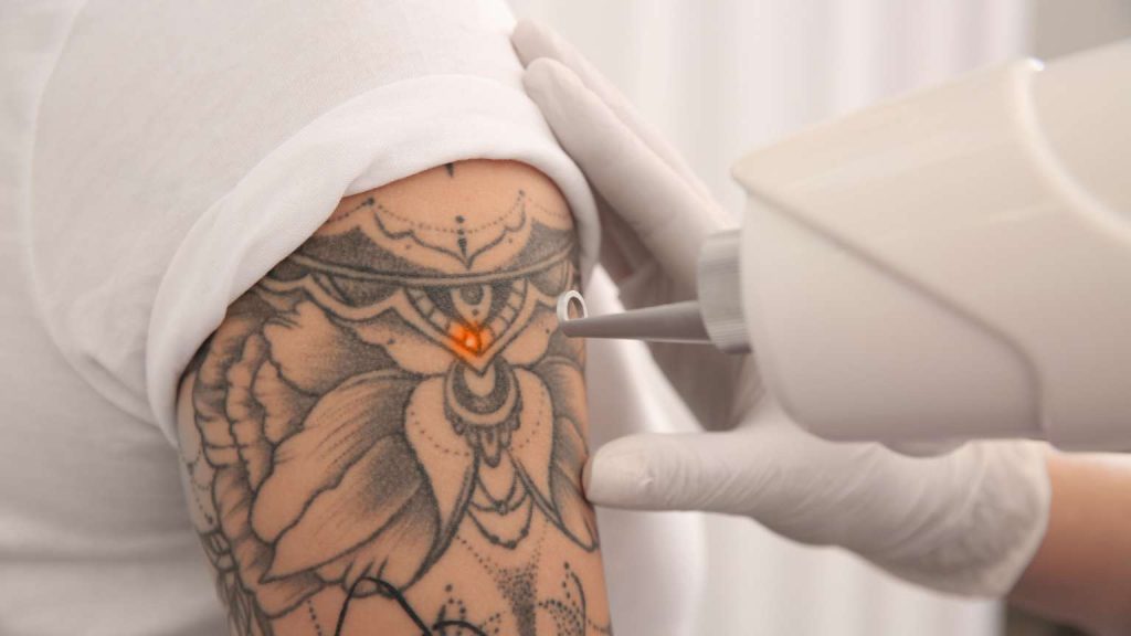 Borrar tatuaje con láser